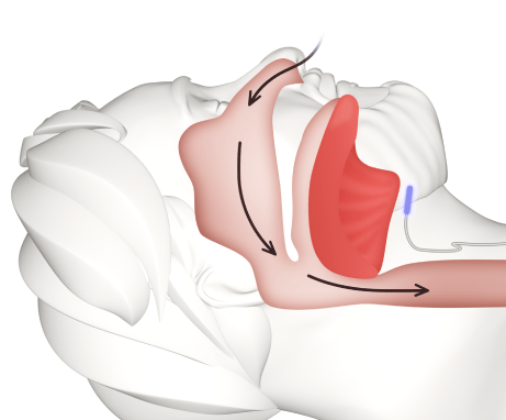 Inspire® Implant